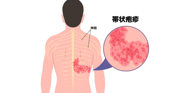定期接種化される帯状疱疹ワクチンQ&A：打つといい人、予防効果、副反応などの写真