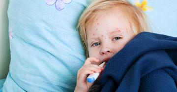 ソビラックス、バルトレックス、カチリなど・・・水痘（水疱瘡、みずぼうそう）に使う薬剤について解説の写真